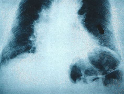 Longfibrose oorzaak